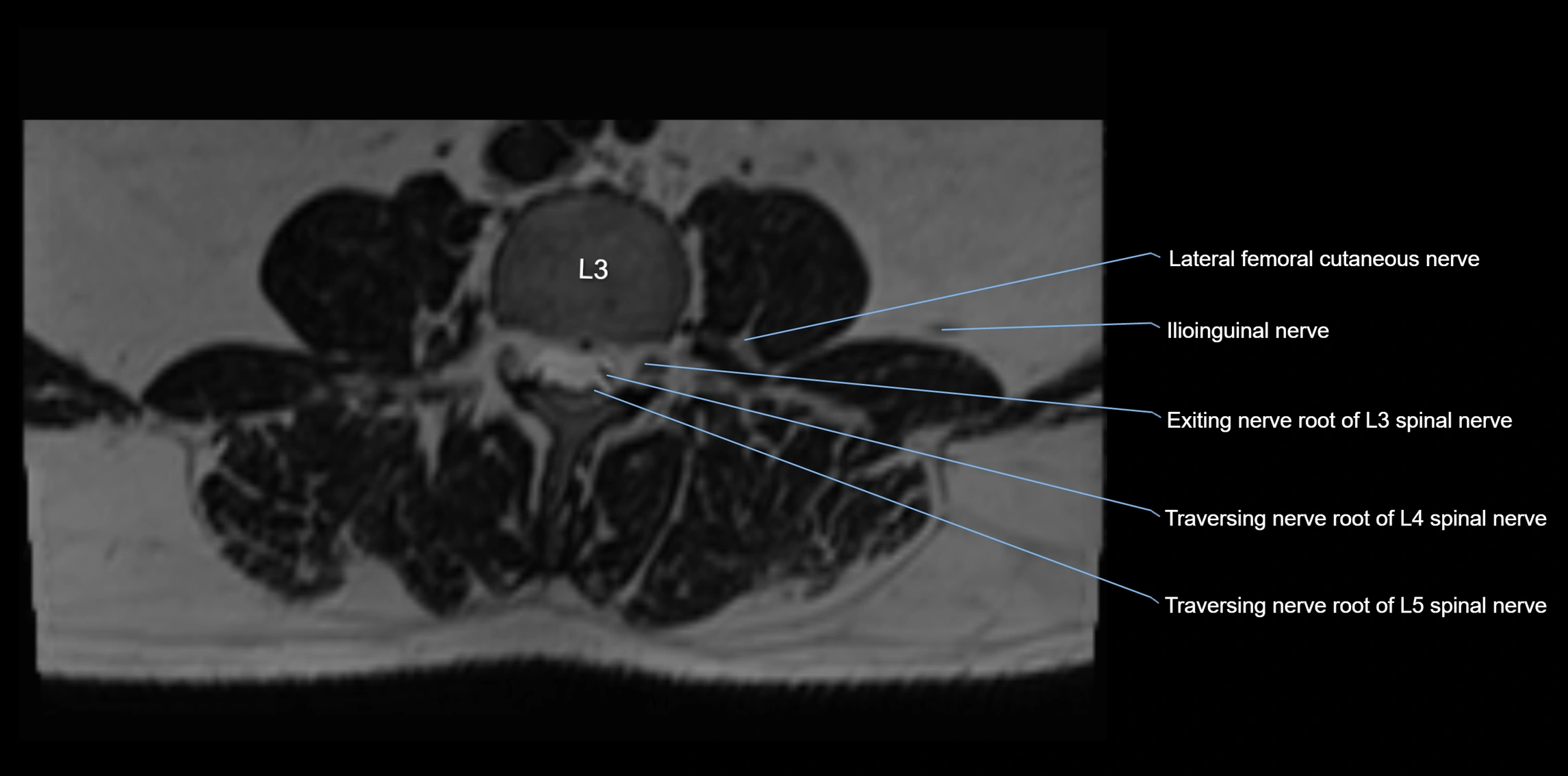 MR lumbosacral plexus axial cross sectional anatomy 3T  radiology  image-img-1008001-00024.webp